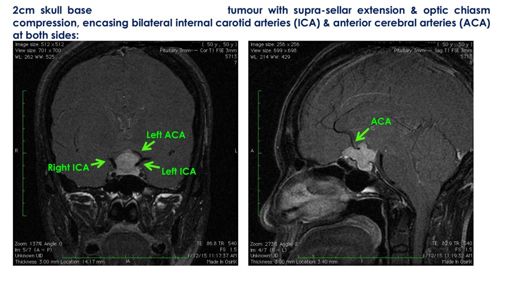 Benign dura mater of skull base - Excel Medical Group