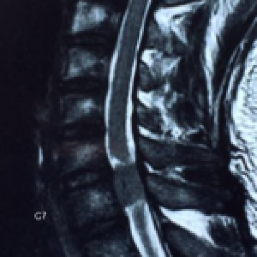 Cervical spinal canal tumors cause sciatica