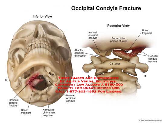 occipital condyle anatomy