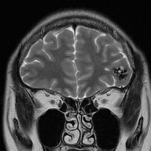 Arteriovenous malformation hemangioma (AVM) of the left frontal cerebral lobe is bleeding