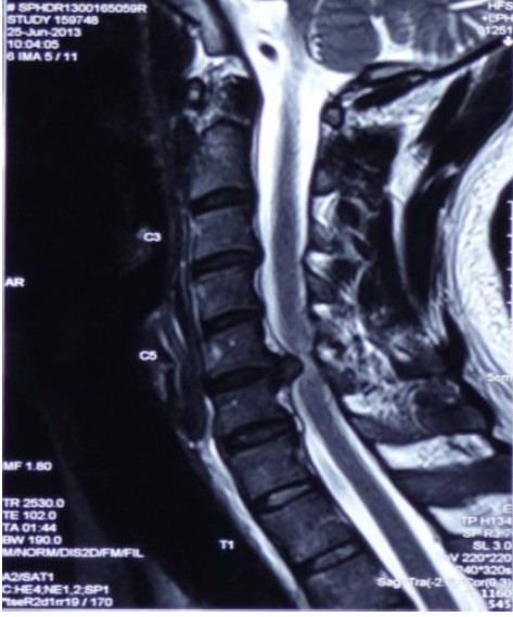Severe cervical disc herniation caused "spinal cord compression