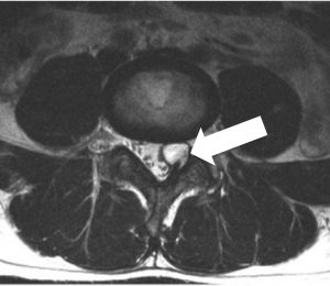 Lumbar facet joint synovial cyst - Excel Medical Group