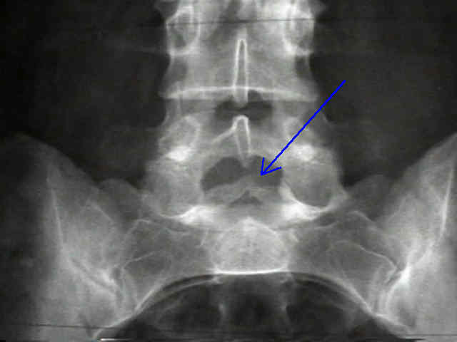 隐性脊柱裂x线图片图片