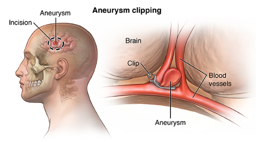 外科手術夾（Aneurysm Clipping）手術