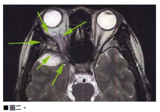 Blurred Vision Brain Tumor Warning Sign Dr Matty Wong Chiropractor